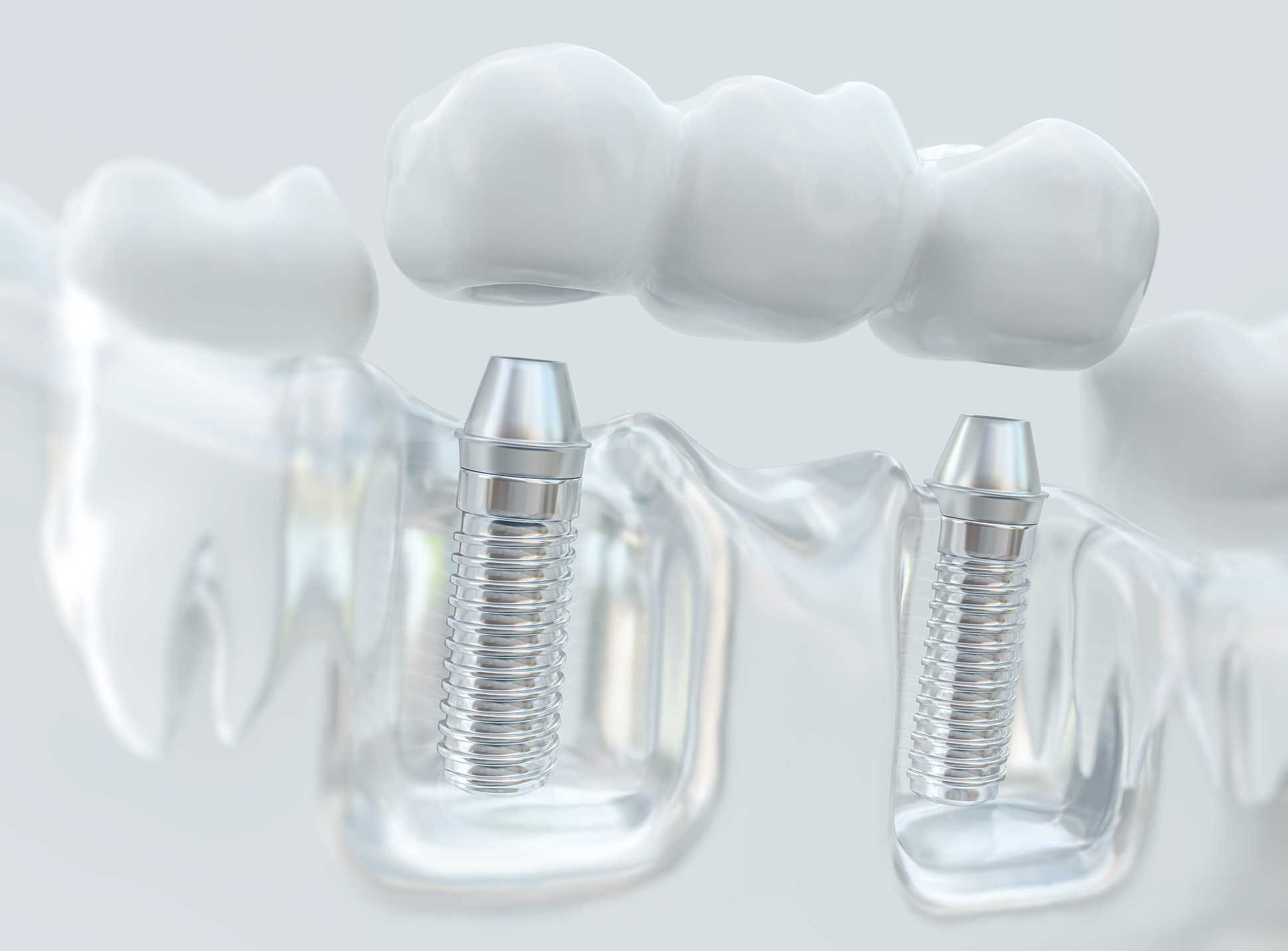 Dental Implants Northampton